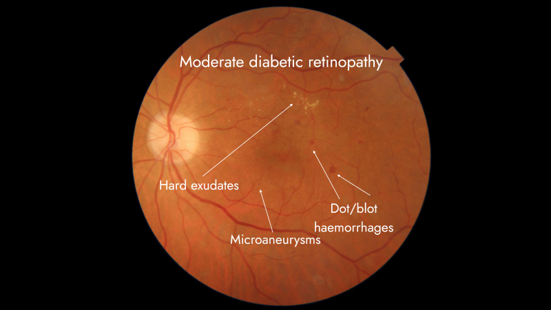 Diabetic Retinopathy diabetic-retinopathy